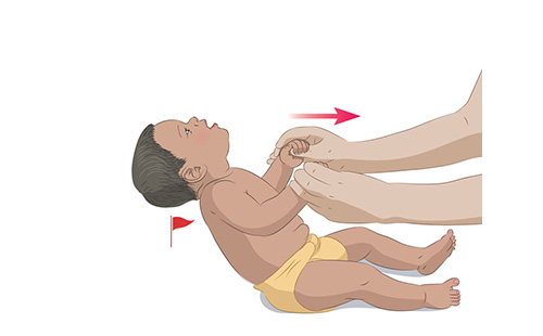 Lifting of child's head is lagging behind the lifting of their body